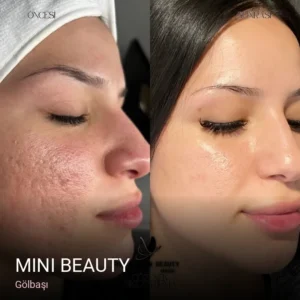 Gölbaşı Mini Beauty — Cilt Bakımı