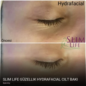 Bakırköy Slim Life Güzellik Hydrafacial Cilt Bakımı — Kirpik Lifting